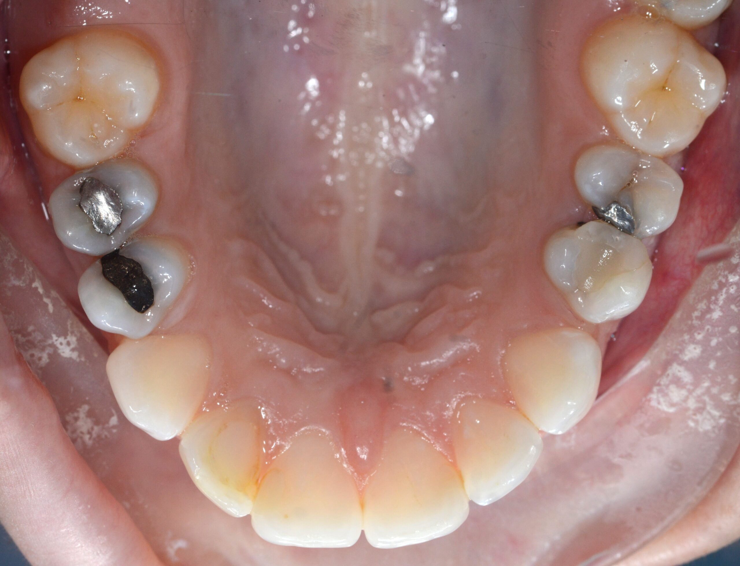 Amalgam Filling